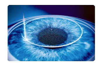 半飞秒近视手术